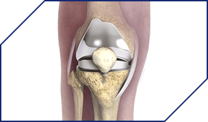 Press Fit Knee Replacement